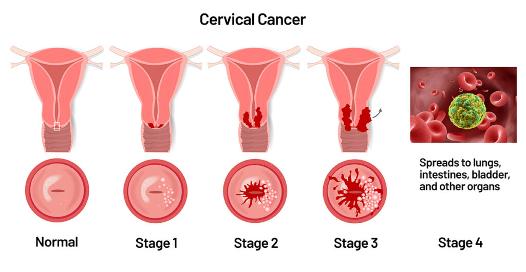 Best doctor for cervical cancer care in Bangalore providing a compassionate consultation at Healius Clinic.