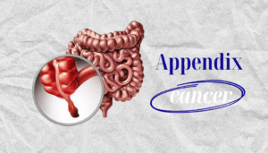 Appendix Cancer Treatment