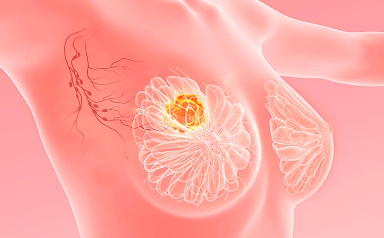 Advanced Breast Cancer Diagnostics at Healius