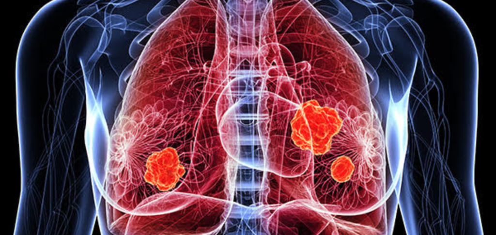 Lung Cancer