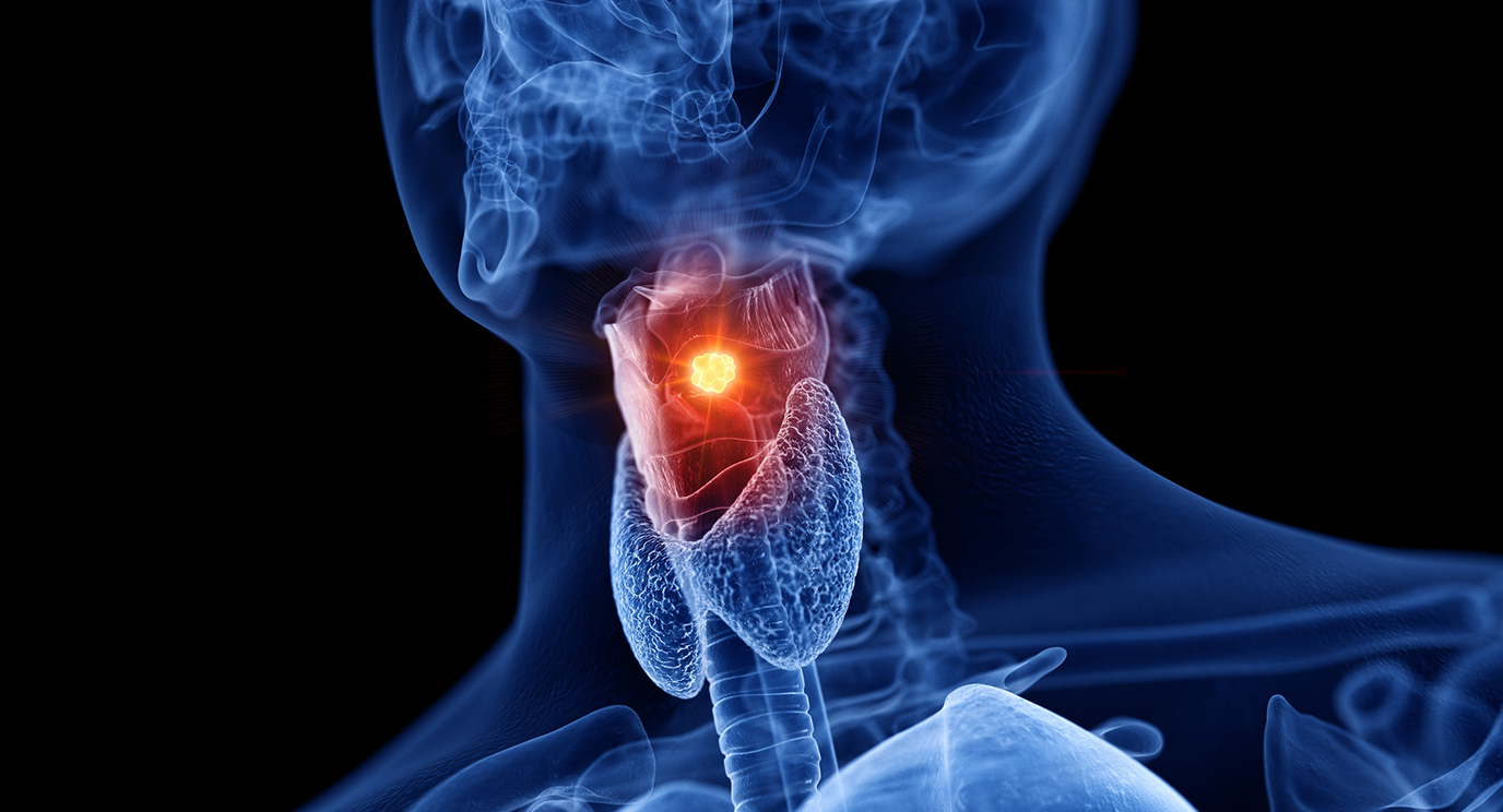 Larynx cancer