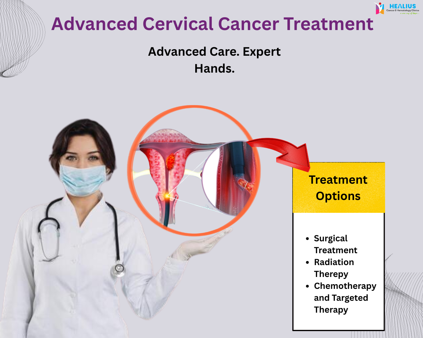advanced cervical cancer illustration highlighting modern treatment options available at Healius clinic.