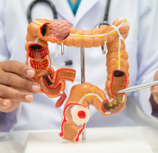 colorectalcancer
