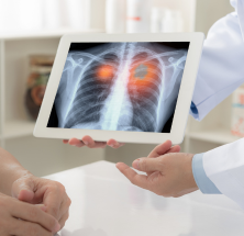 lungcancer