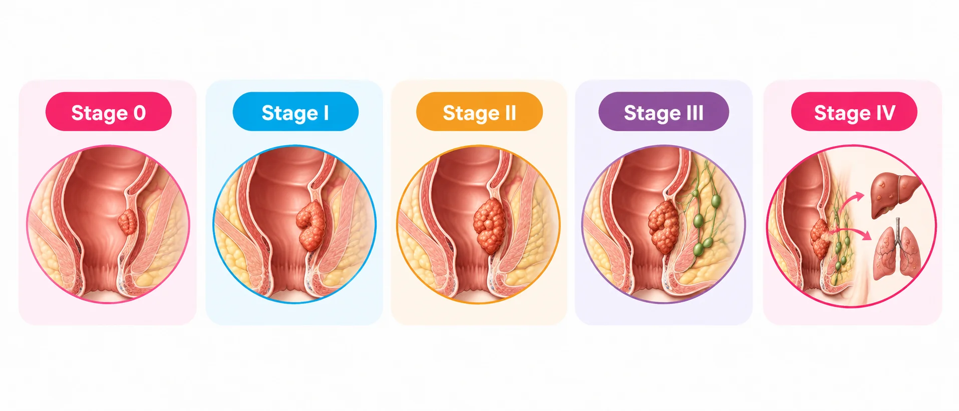 rectal cancer treatment